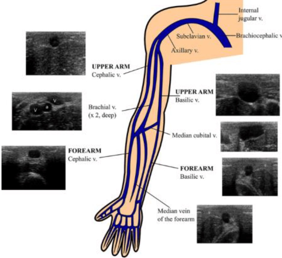 Upper-limb veins with ultrasound appearances