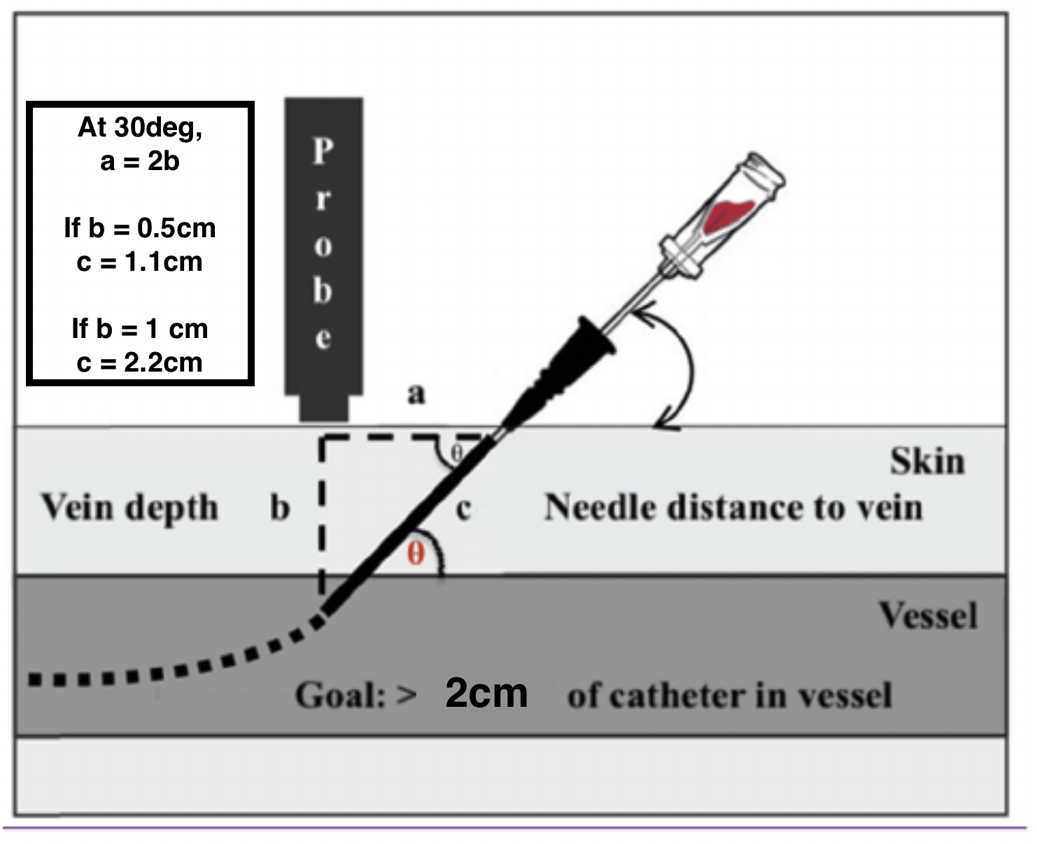 Geometry of cannula length vs vein depth